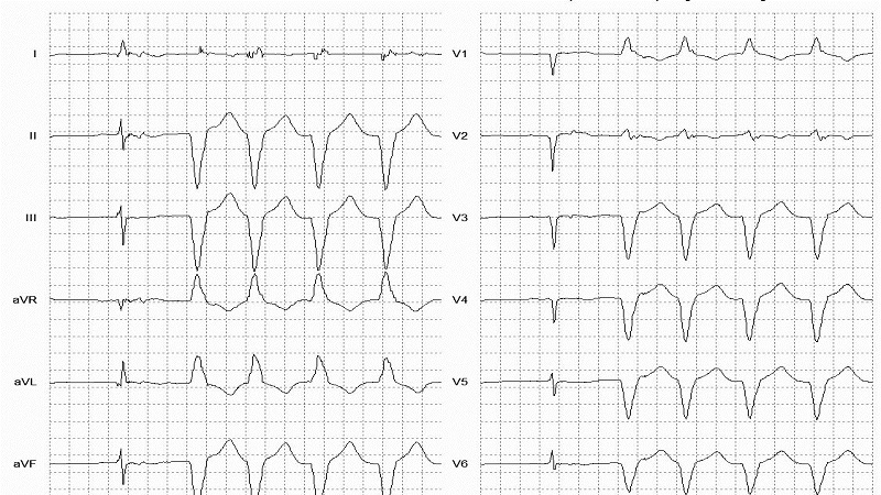 Idioventricular Rhythm 12 Lead EKG